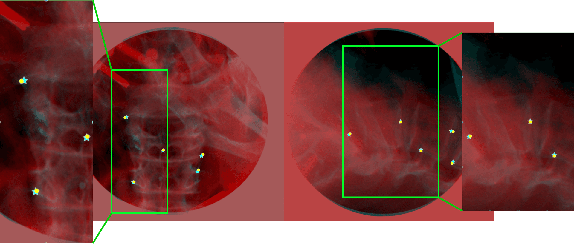 Blended DRR-X-ray overlay with predicted landmarks on cadaver.